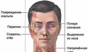 Общие первичные признаки наступающего мозгового удара