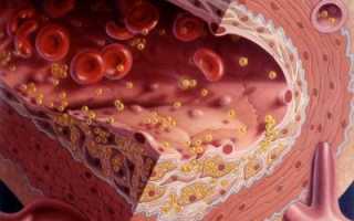 Показатели липидограммы: как распознать болезнь?