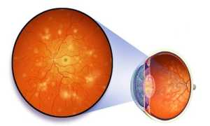 Диабетическая ангиопатия: причины и способы лечения заболевания
