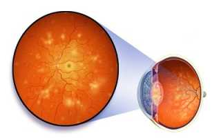 Диабетическая ангиопатия: причины и способы лечения заболевания
