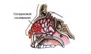 Прижигание слизистой носа: показания к проведению, особенности и эффекты процедуры