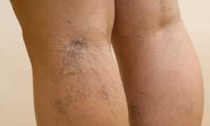 Сосудистые звездочки и сетка на нижних конечностях: причины появления, эффективные методы лечения