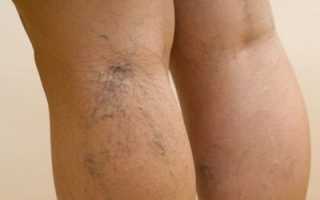 Сосудистые звездочки и сетка на нижних конечностях: причины появления, эффективные методы лечения