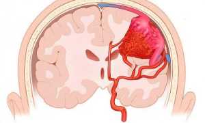 Классификация, причины возникновения и методы лечения аневризмы сосудов головы