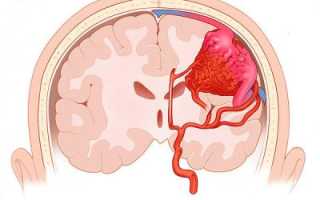 Классификация, причины возникновения и методы лечения аневризмы сосудов головы