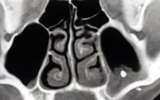 Инородное тело в гайморовой пазухе: способы лечения, симптомы и последствия