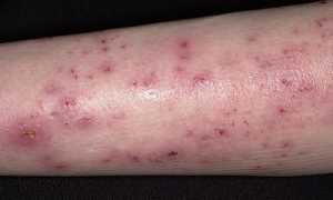 Кожные проявления варикоза: экзема