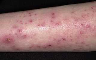 Кожные проявления варикоза: экзема