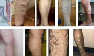 Причины образования шишек на венозных сосудах