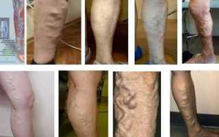 Причины образования шишек на венозных сосудах