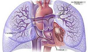 Разновидности легочной гипертензии, причины развития и способы лечения