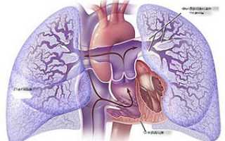 Разновидности легочной гипертензии, причины развития и способы лечения