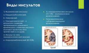 В чем особенности лакунарно-ишемического удара?