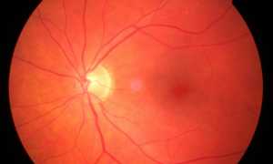 Утрата зрительных функций при инсульте