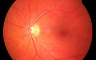 Утрата зрительных функций при инсульте