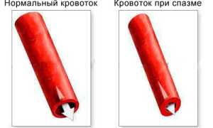 Церебральный ангиоспазм: подходы традиционной и нетрадиционной медицины