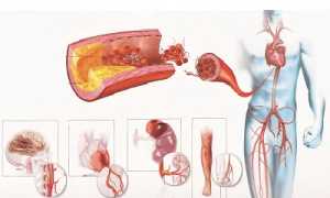 Склеротическое поражение сосудов головного мозга: причины и стадии развития, терапия недуга