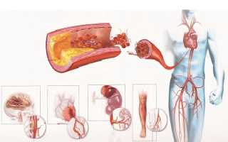 Склеротическое поражение сосудов головного мозга: причины и стадии развития, терапия недуга