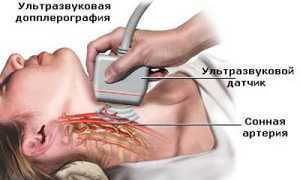 Ультразвуковая диагностика сосудистой патологии головного мозга