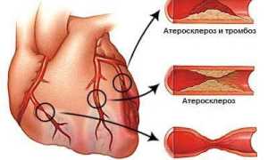 Стентирование сосудов сердца: показания, особенности проведения вмешательства