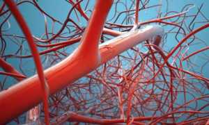 Чем опасен илеофеморальный вид тромбоза?