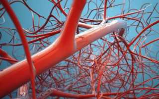 Чем опасен илеофеморальный вид тромбоза?