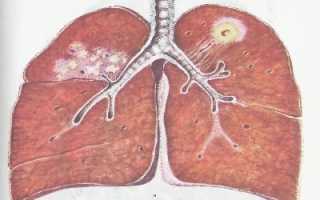 Особенности инфильтративной формы туберкулеза