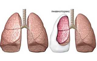 Пневмоторакс: что собой представляет патология?