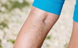 Предупреждение тромбоза: народные и медицинские способы