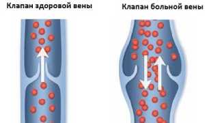 Что делать, если появились варикозные узлы на венах ног?