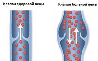 Что делать, если появились варикозные узлы на венах ног?