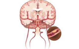 Ишемия мозга: причины, симптомы, диагностика и лечение