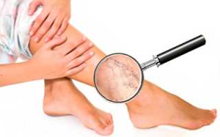 Какие мази помогут от варикоза?