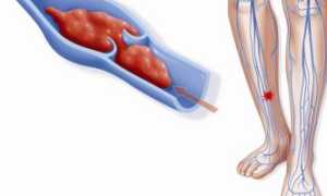 Острая форма тромбофлебита