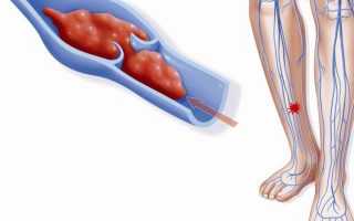 Острая форма тромбофлебита