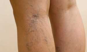 Что такое тромбоэмболия легочной артерии?