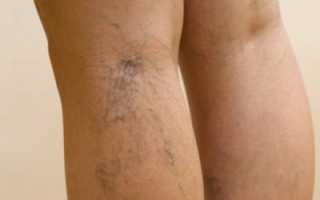 Что такое тромбоэмболия легочной артерии?