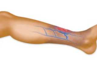 Лечение тромбофлебита посредством лекарственных препаратов