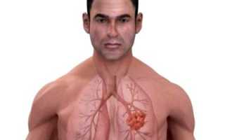 Легочная эмфизема: разновидности и классификация