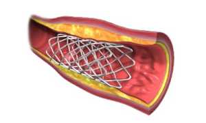 Стентирование: суть вмешательства, показания к проведению, клинические особенности операции