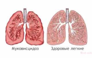 Что такое муковисцидоз простыми словами. Базовые принципы лечения и поддержания здоровья больным