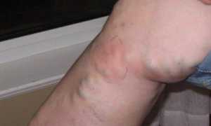 Развитие поверхностного тромбофлебита: диагностика и лечение