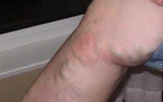 Развитие поверхностного тромбофлебита: диагностика и лечение