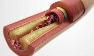 Как проявляются атеросклеротические изменения сосудов?