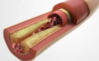 Как проявляются атеросклеротические изменения сосудов?