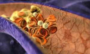 Медикаментозное лечение тромбов: как сделать правильный выбор?