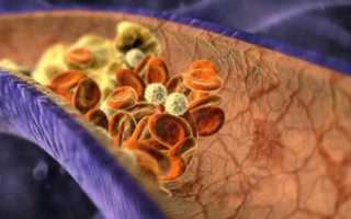 Медикаментозное лечение тромбов: как сделать правильный выбор?