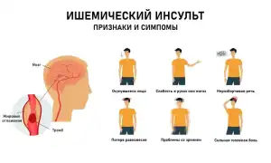 Симптоматика ишемического инсульта и ее особенности