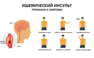 Симптоматика ишемического инсульта и ее особенности