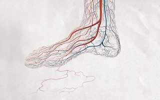 Стоит ли бегать при варикозе?